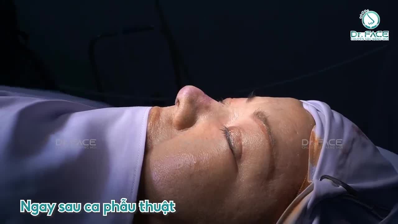 Chiếc mũi bẩm sinh này RẤT KHÓ vì MÔ DÀY VÀ TO BÈ