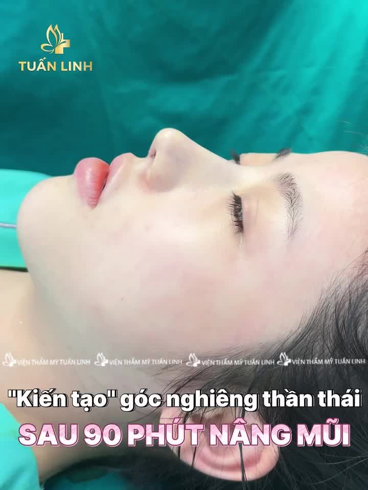 KIẾN TẠO GÓC NGHIÊNG THẦN THÁI SAU 90 PHÚT – ĐẸP TỰ NHIÊN, TỰ TIN TỎA SÁNG!