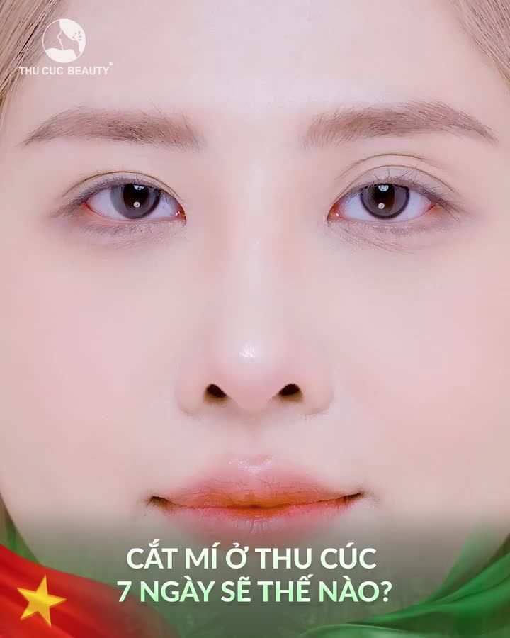 Chọn Mắt TC - Khắc phục mọi khuyết điểm mắt An toàn. Không đau. Không sưng Không lộ sẹo. Đẹp ngay sau làm