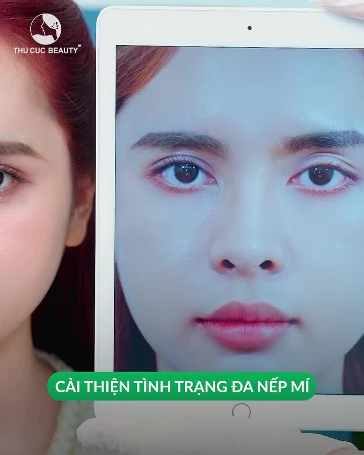 Cắt mí đẹp ngay đón Đại lễ cùng ưu đãi giảm 35% với Thu Cúc nhé