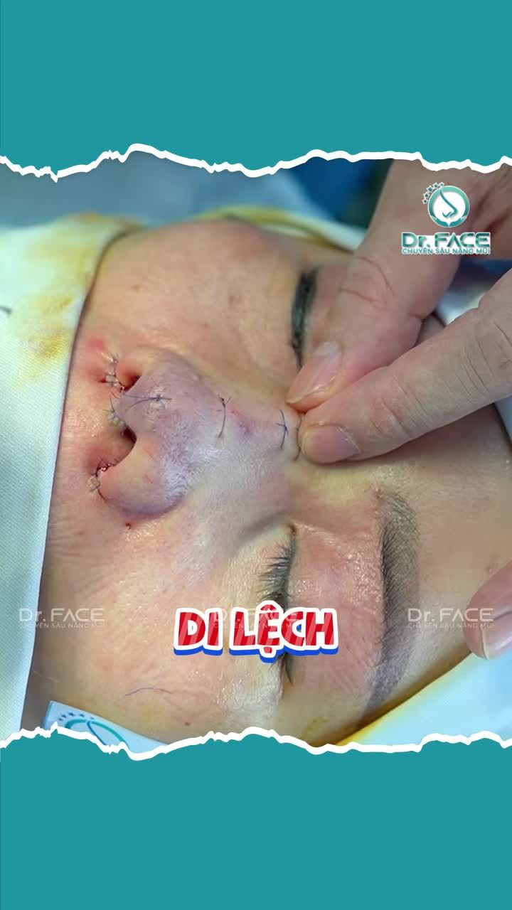 CHỈ gì mà kh.âu “CHẰNG CHỊT” trên mũi thế kia?