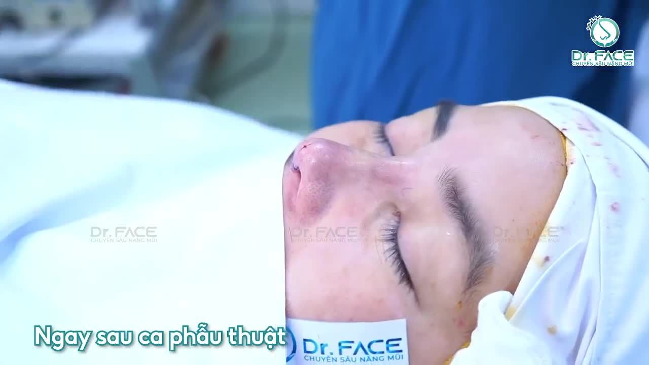 Một Ca Mũi Mới Sụn Sườn Vô Cùng Dễ Đẹp