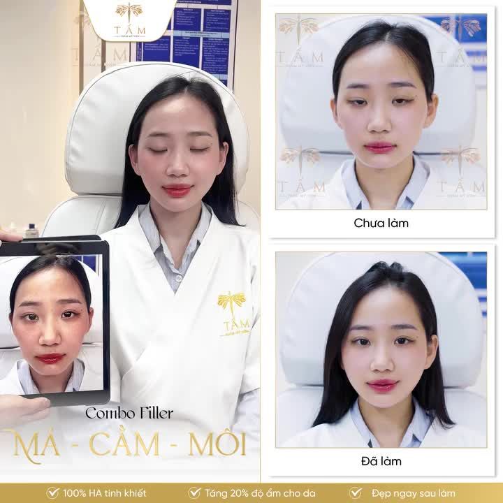 F5 GIAO DIỆN VỚI COMBO FILLER MÁ - MÔI - CẰM