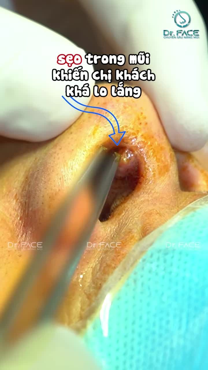 CỤC SẸO TO QUÁ, lo lắm bs ơi!