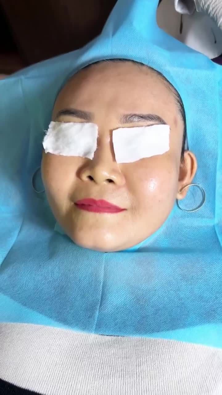 Quý cô U40 tự ti SẸO RỖ VÙNG MẶT lâu năm đến Khoa Thẩm mỹ da JW cải thiện 99% chỉ sau 3 buổi điều trị