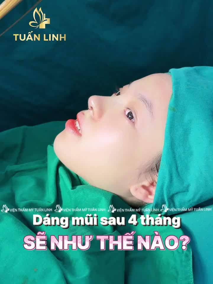Dáng mũi sau 4 tháng sẽ như thế nào???