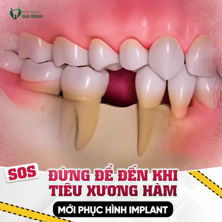 ĐỪNG ĐỢI TIÊU XƯƠNG MỚI LO TRỒNG RĂNG IMPLANT!