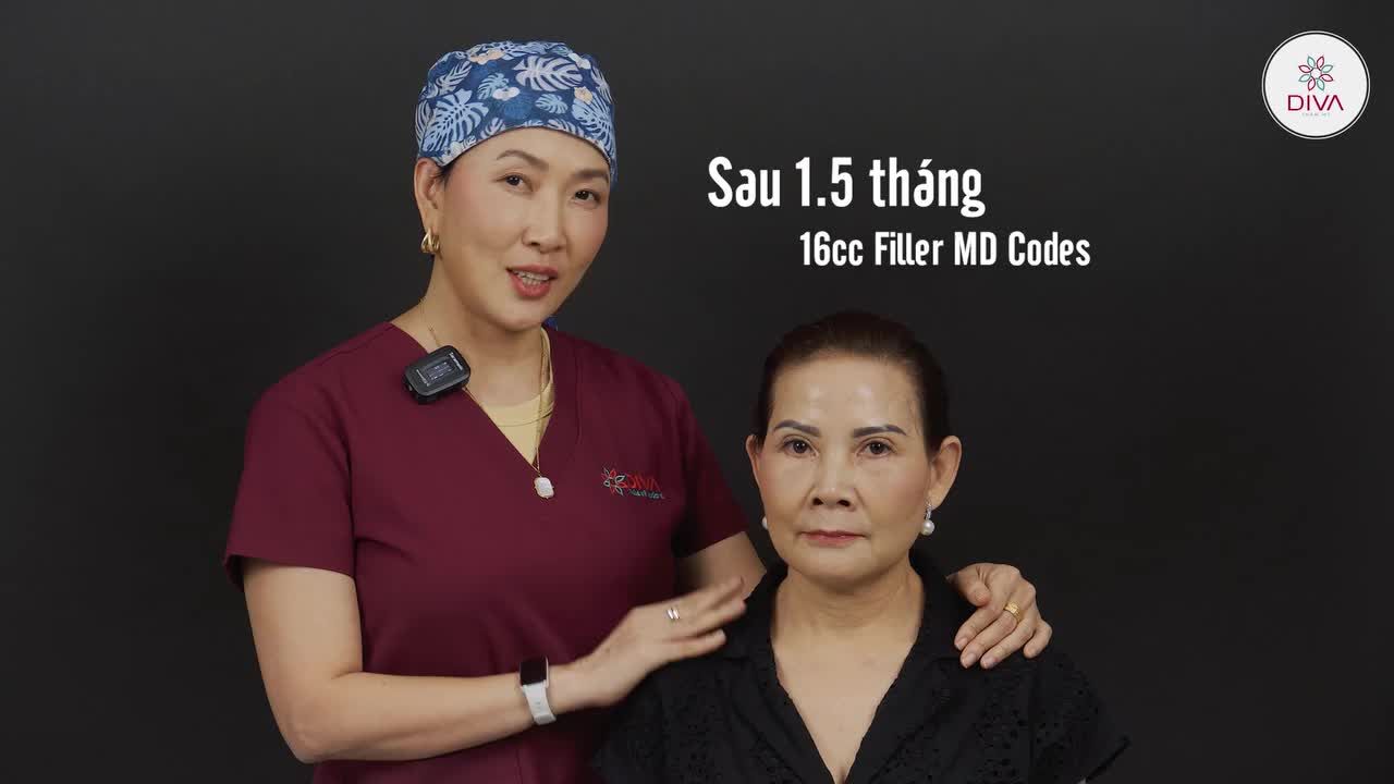 PHÂN TÍCH KQ SAU 1,5 THÁNG THỰC HIỆN 16CC FILLER MD CODES KẾT HỢP CÙNG PROFHILO