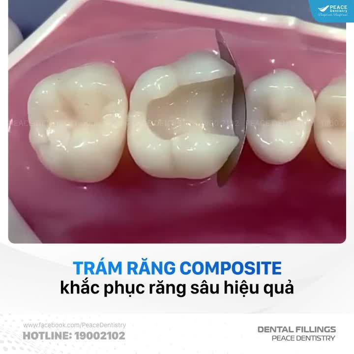 Răng sâu vỡ lớn vẫn có thể khắc phục tốt bằng trám răng với vật liệu Composite tại Peace Dentistry