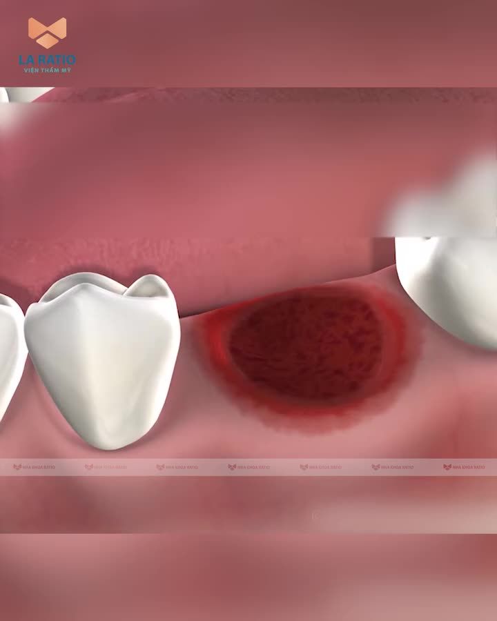 TẠI SAO CẦN GHÉP XƯƠNG TRONG CẤY GHÉP IMPLANT