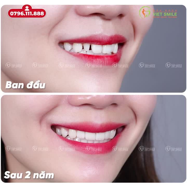 TẠM BIỆT RĂNG KHUYẾT ĐIỂM ĐÓN NỤ CƯỜI TỰ TIN