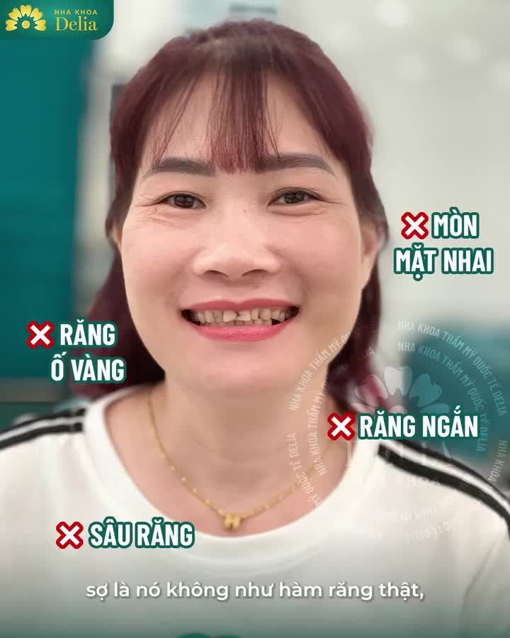 Chị Thanh Huyền (TX Sơn Tây) hơn 40 năm sống chung với hàm răng: Ố vàng, mòn mặt nhai, ảnh hưởng đến sức khỏe răng miệng và thẩm mỹ.