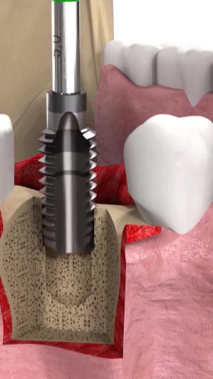 CÓ THỂ TRỒNG NHIỀU RĂNG CÙNG MỘT LÚC KHÔNG