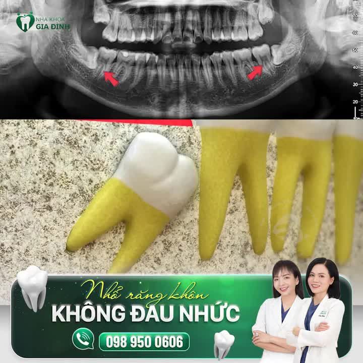 ĐỪNG DẠI CHỌN BỪA KHI NHỔ RĂNG KHÔN