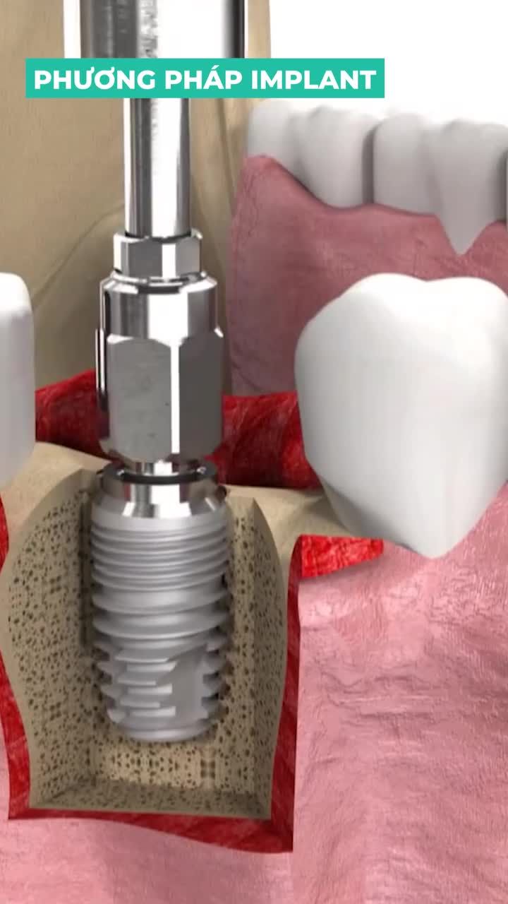 NHỮNG BƯỚC CẦN CHUẨN BỊ KHI CẤY IMPLANT