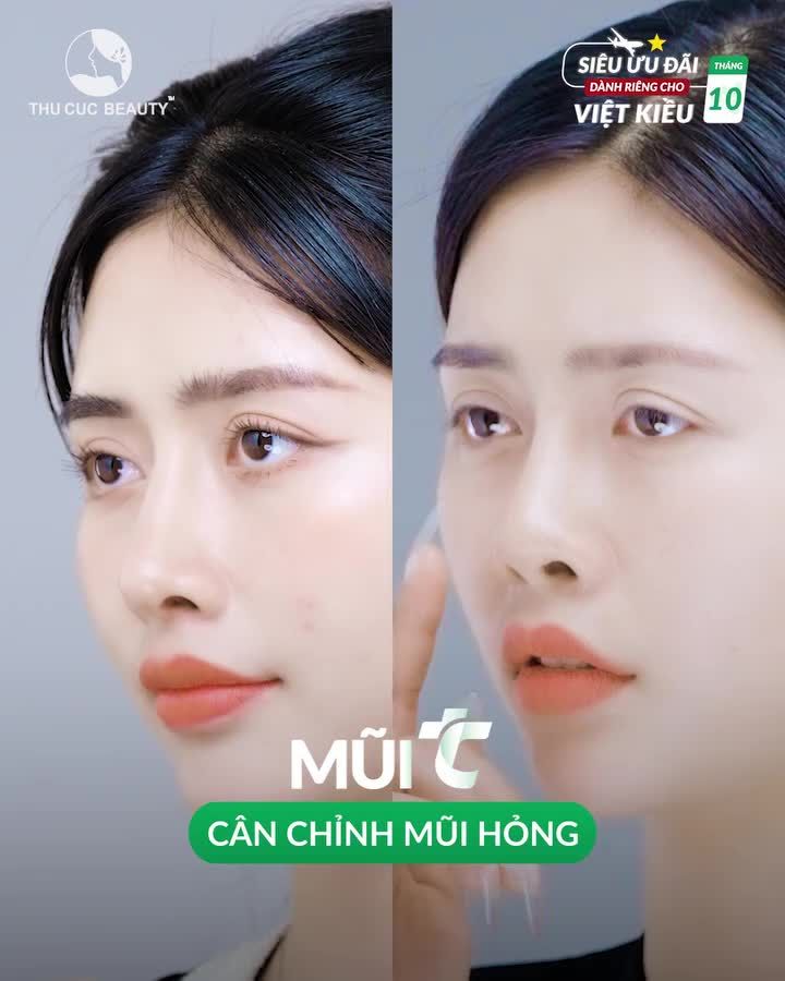 Khuôn mặt thiếu điểm nhấn vì chiếc mũi tẹt Nhiều chị em Việt Kiều đã lựa chọn Mũi TC