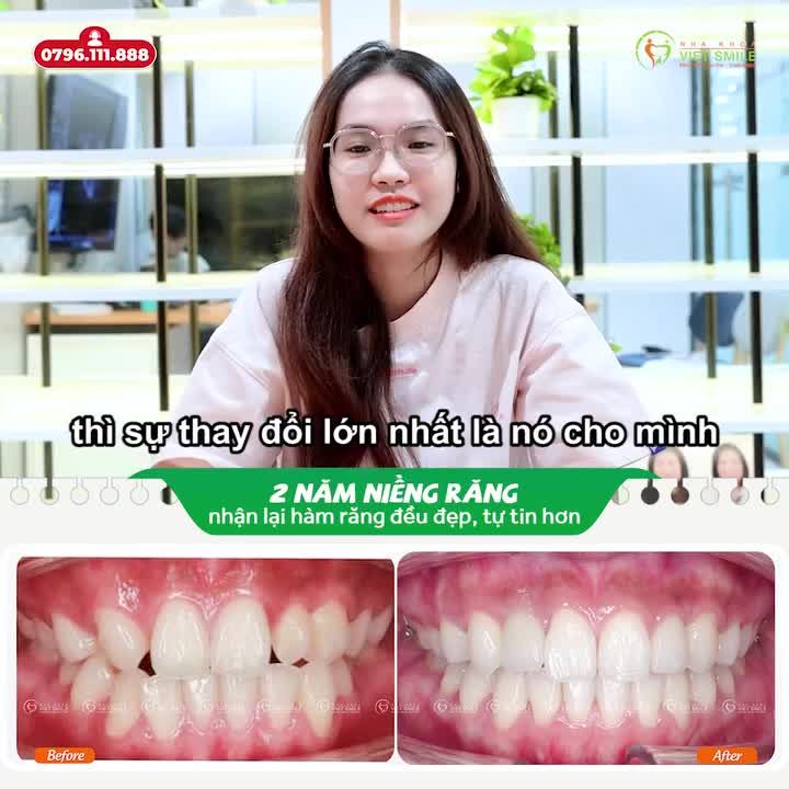 2 NĂM NIỀNG RĂNG NHẬN LẠI HÀM RĂNG ĐỀU ĐẸP, TỰ TIN