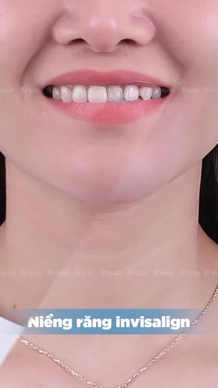 NIỀNG RĂNG VÔ HÌNH - TỰ TIN LÀ CHÍNH MÌNH