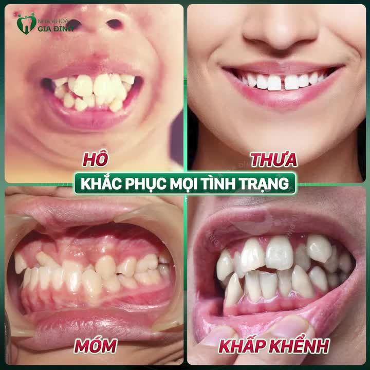 NIỀNG RĂNG AN TOÀN - KHÔNG LO BIẾN CHỨNG CÙNG BÁC SĨ CKI TRẦN THỊ HỒNG