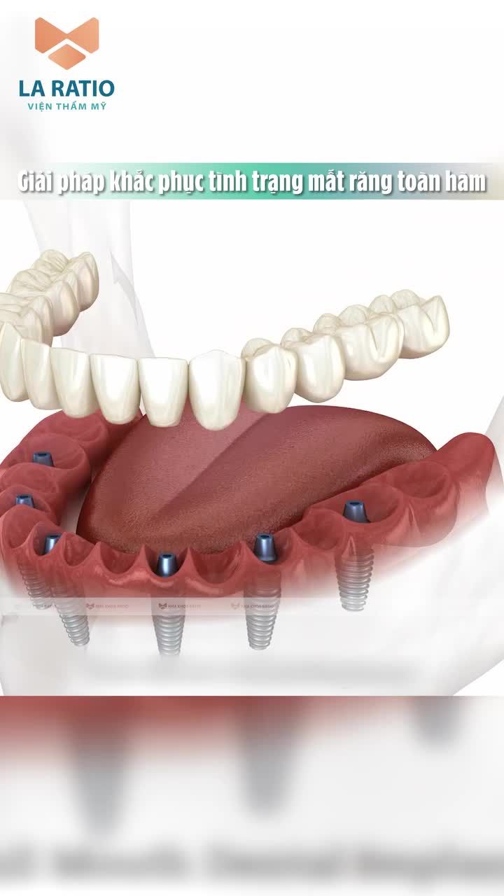 Mất răng toàn hàm - Đâu là giải pháp khắc phục hiệu quả?