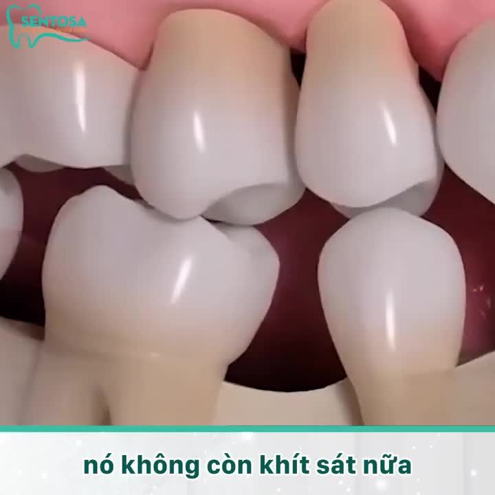 MẤT RĂNG LÂU NGÀY CÀNG TIỀM ẨN NHIỀU NGUY CƠ VỀ SỨC KHỎE!
