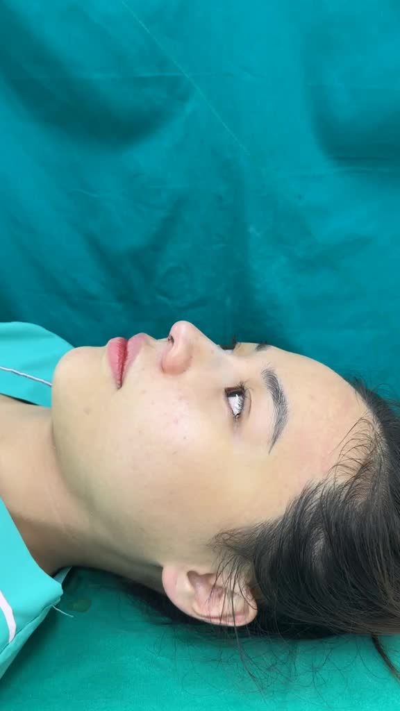 Case mũi cấu trúc vừa hoàn thành