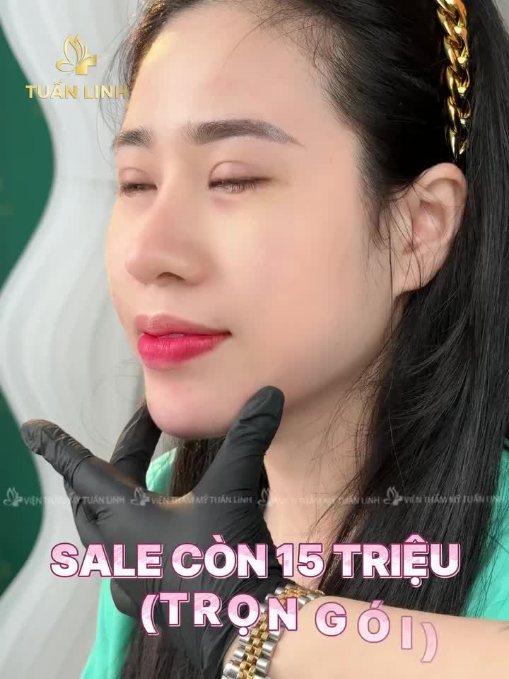Độn cằm Vline -Sở hữu ngay gương mặt thanh tú, đẹp tự nhiên - Giá Sale chỉ còn 15Triệu ( trọn gói)!!