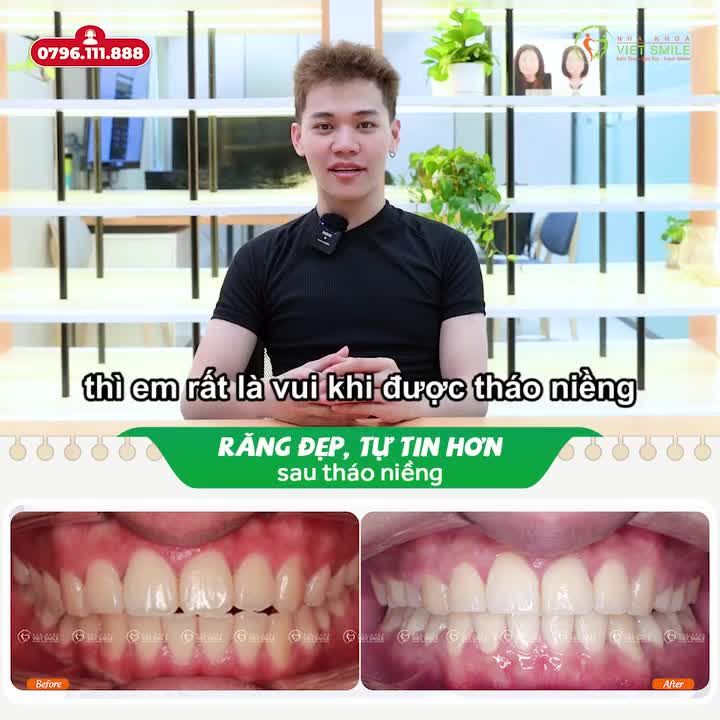 RĂNG ĐẸP, TỰ TIN HƠN SAU THÁO NIỀNG