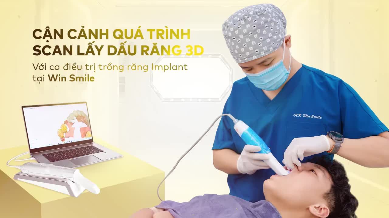 QUY TRÌNH LẤY DẤU RĂNG BẰNG CÔNG NGHỆ SCAN 3D - ĐỘ CHÍNH XÁC CAO MANG LẠI NỤ CƯỜI NHƯ Ý