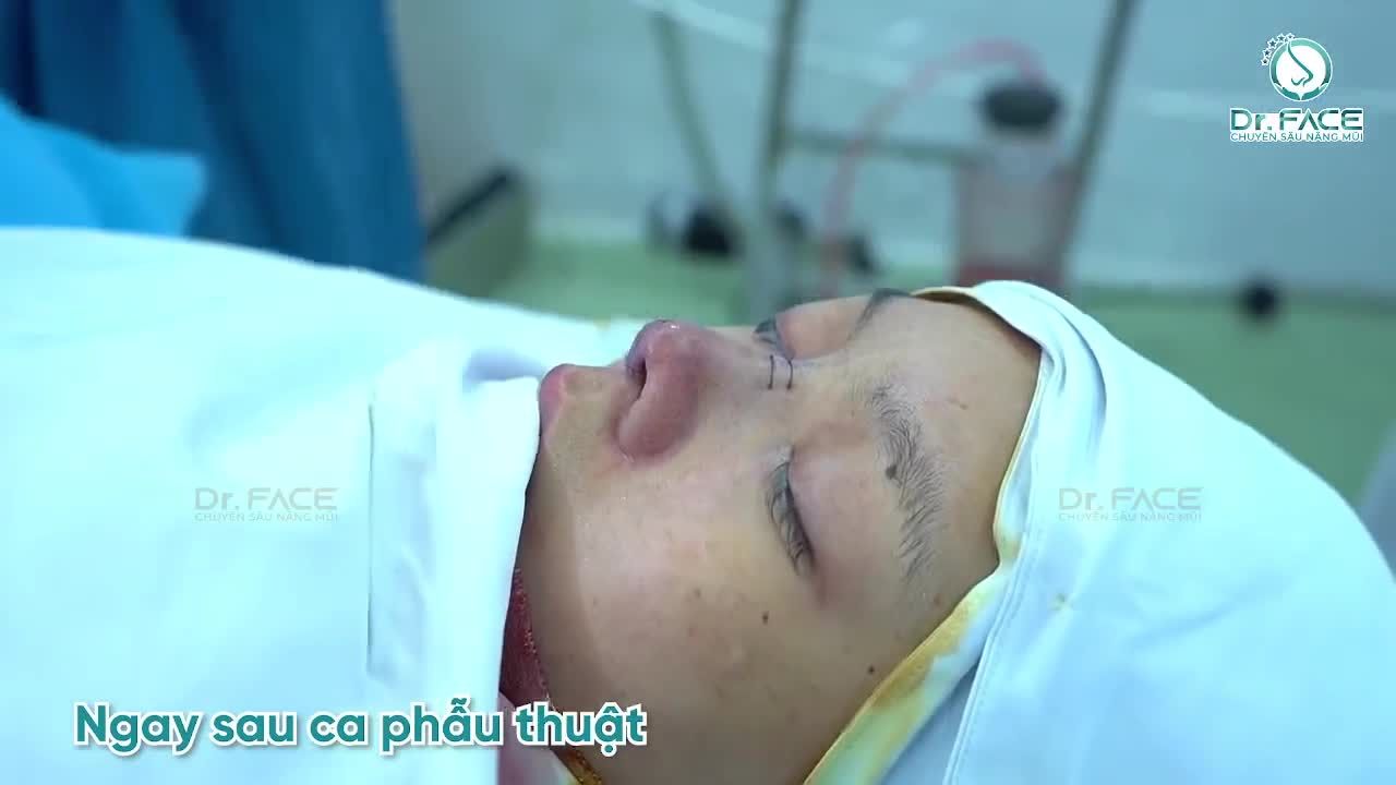 BIẾN HÓA chiếc mũi THẤP BÈ này với SỤN SƯỜN xem nào…
