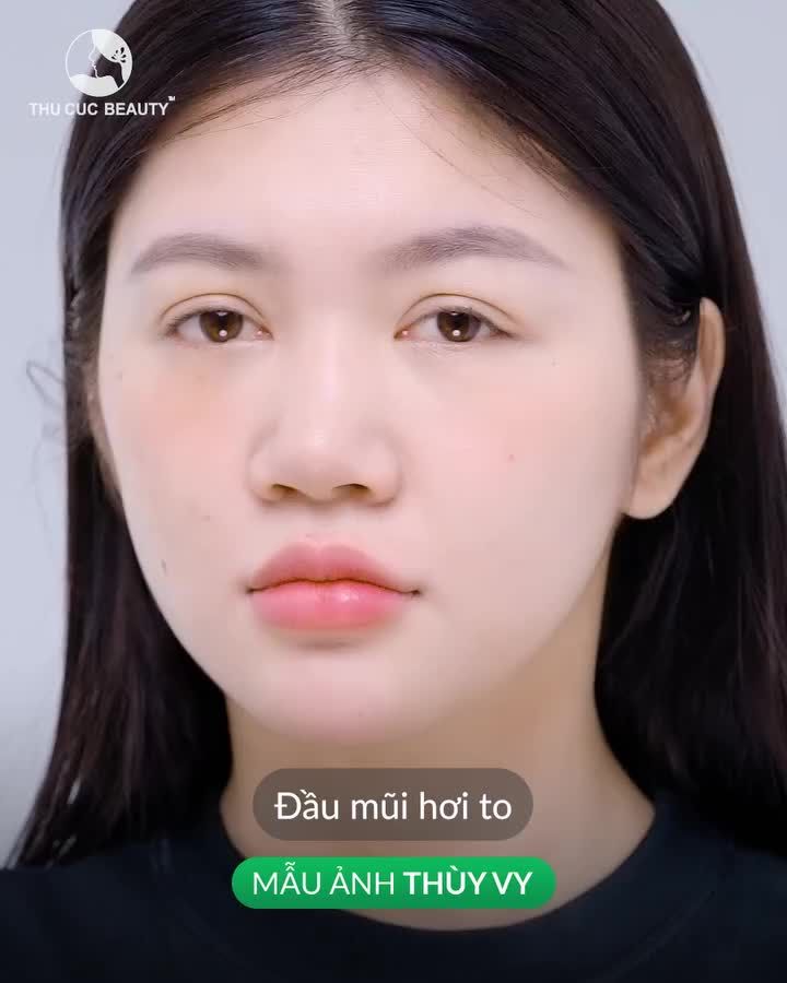 Hết tự ti sau 15 phút nâng mũi
