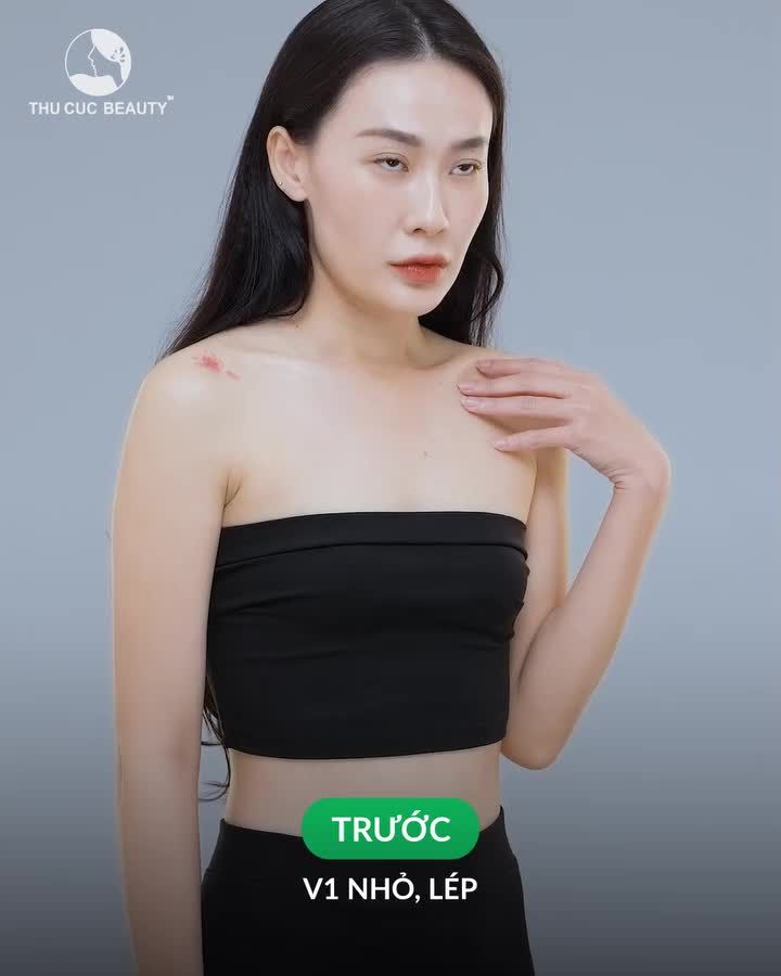 Nâng ngực 7 ngày có ngay V1 đẹp tự nhiên? Tin được không?