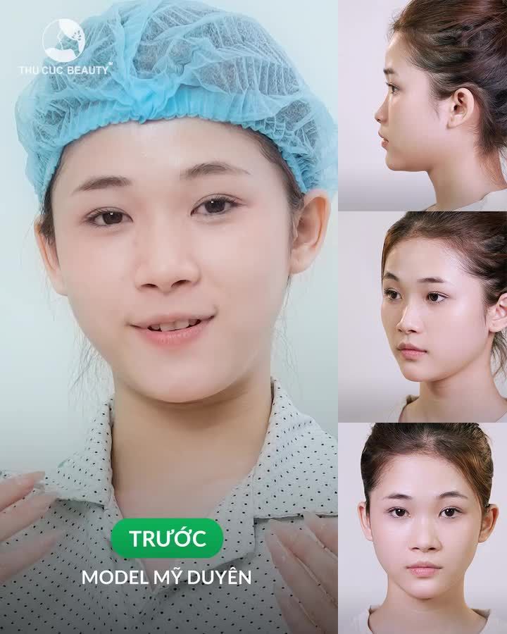 Bye mũi tẹt. Đẹp mê ly Sụn mũi an toàn, chính hãng Đẹp tự nhiên, hài hòa khuôn mặt Không sưng đau. Không nghỉ dưỡng