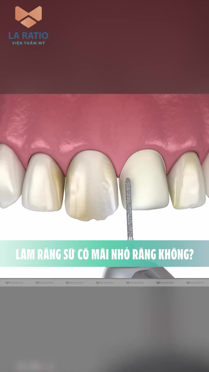 LÀM RĂNG SỨ CÓ MÀI NHỎ RĂNG KHÔNG?