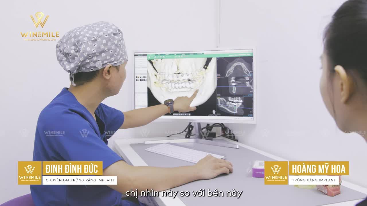 TRỒNG RĂNG IMPLANT THAY THẾ CẦU RĂNG SỨ - LỰA CHỌN BẢO VỆ SỨC KHỎE RĂNG MIỆNG TOÀN DIỆN