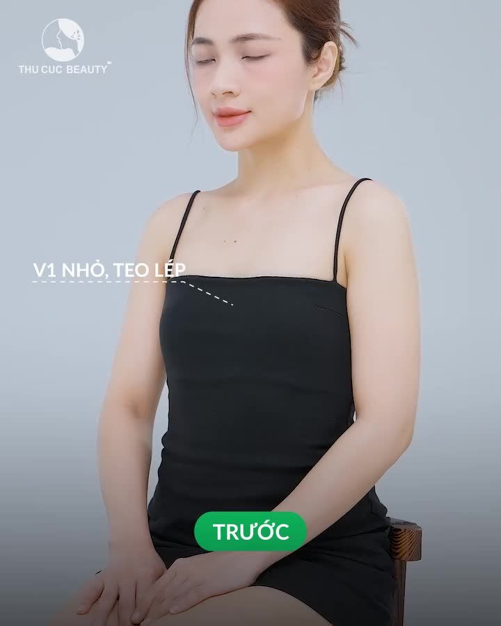 Giảm ngay 40% cho 10 chị em nhanh tay đăng ký nâng ngực tại TC