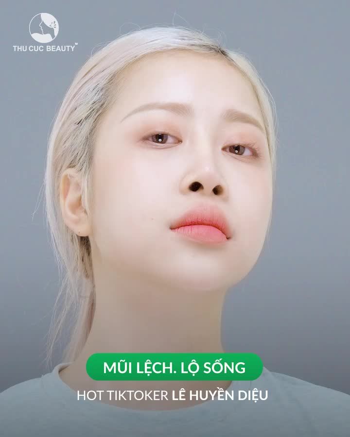 Ai đã từng nâng mũi nhưng bị lỗi, hỏng? hãy đến ngay TC nhé