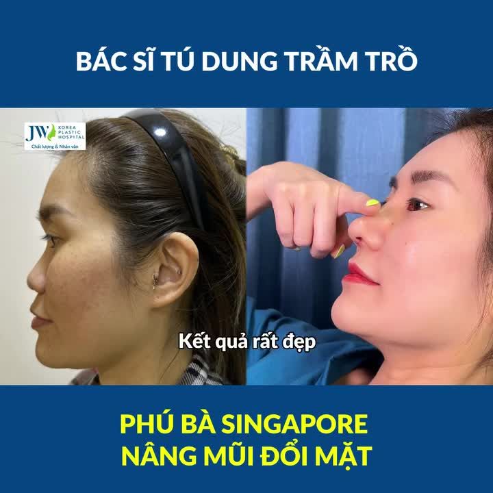 Bác sĩ Tú Dung TRẦM TRỒ phú bà Singapore chốt đơn combo Nâng mũi S Line, Nâng ngực TRÙNG TU nhan sắc