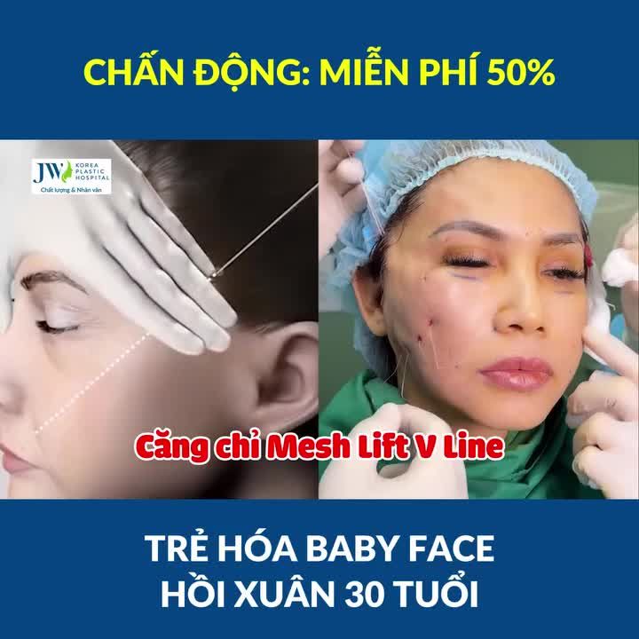 Bác sĩ Tú Dung TUNG CHIÊU căng chỉ Meshlift, cấy mỡ mặt giúp Việt kiều Mỹ U60 sở hữu MẶT BABY gái 30