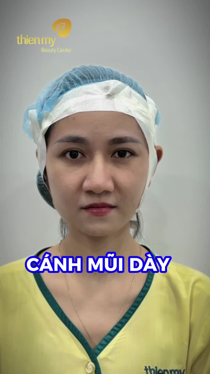 Sau 90’ nâng mũi sẽ thay đổi như thế nào?