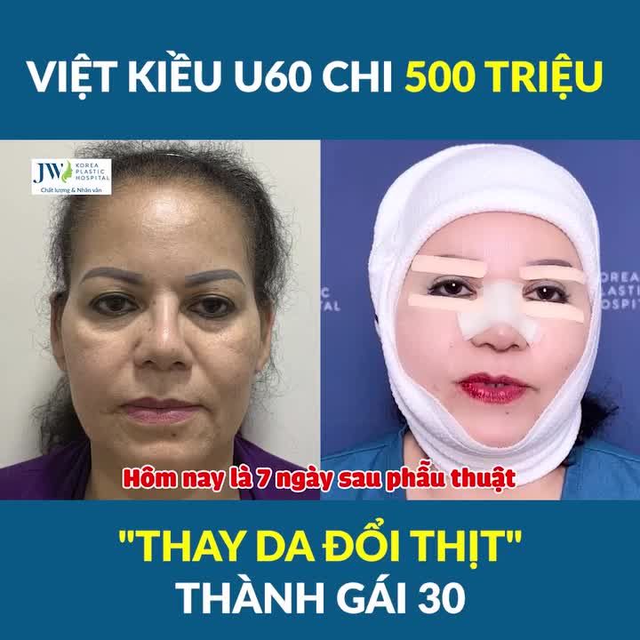 HOT HƠN GIÁ VÀNG Việt kiều Mỹ U60 chi 500 TRIỆU Phẫu thuật thẩm mỹ thay da đổi thịt ĐẸP như GÁI 30