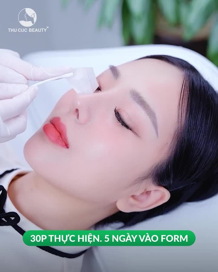 KH Nhi Diệu không còn tự ti vì sống mũi gồ, cánh mũi to sau 30P nâng mũi