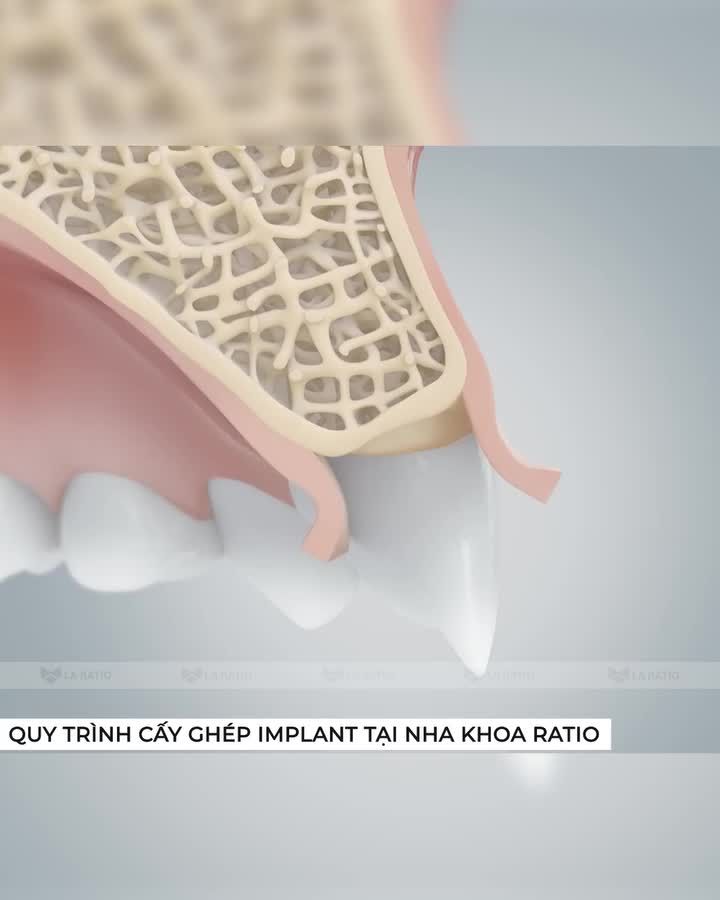 Quy trình cấy ghép Implant diễn ra như thế nào?