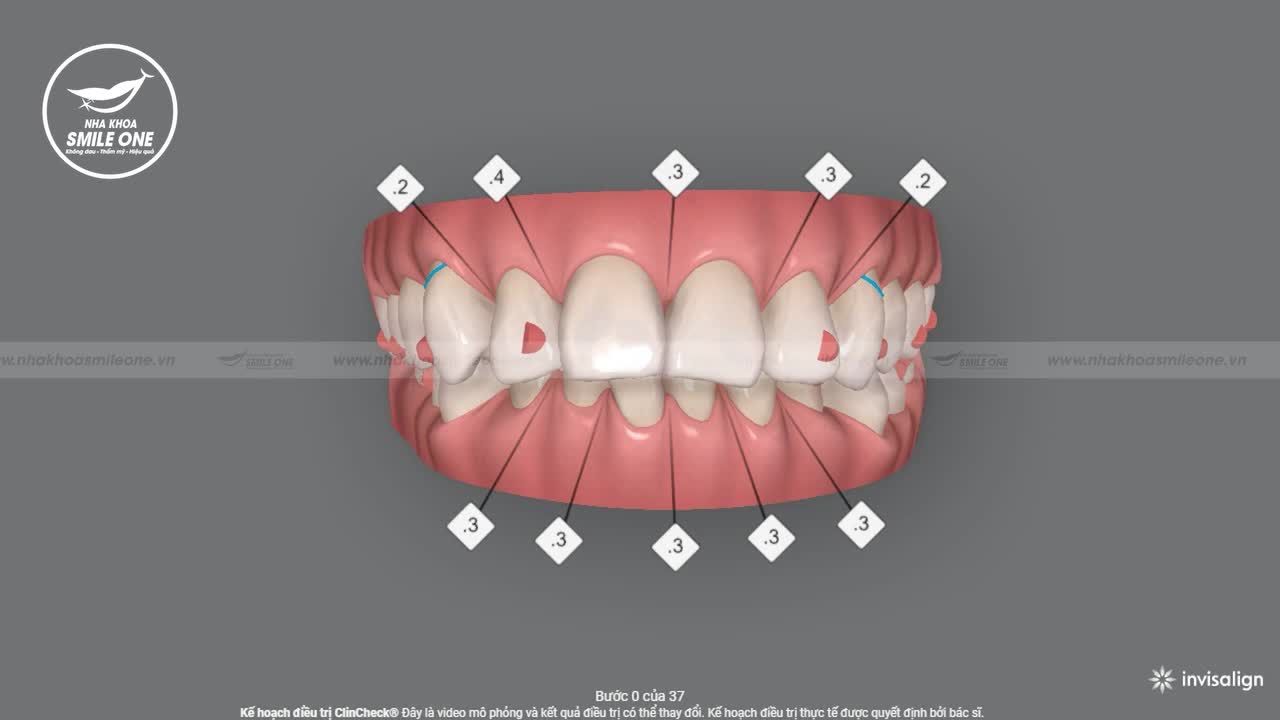 CLINCHECK 3D - XEM TRƯỚC KẾT QUẢ NIỀNG RĂNG NGAY TỪ KHI CHƯA BẮT ĐẦU NIỀNG.