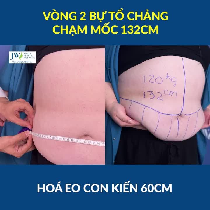 HÚ HỒN bụng TO CHÀ BÁ 132CM của Nữ Việt kiều Canada Bác sĩ JW Căng da, Hút mỡ bụng SIẾT EO CON KIẾN