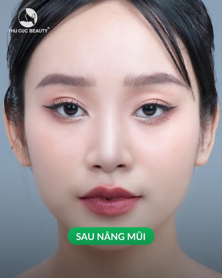 Nâng mũi xong không tin đó là mình