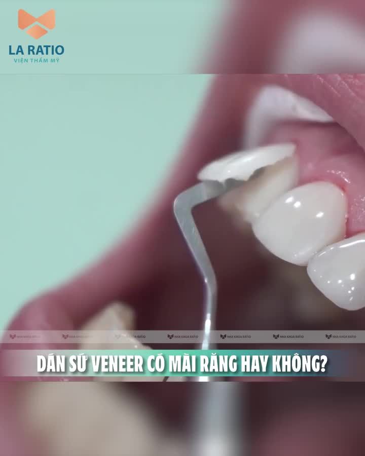 DÁN SỨ VENEER CÓ MÀI RĂNG HAY KHÔNG?