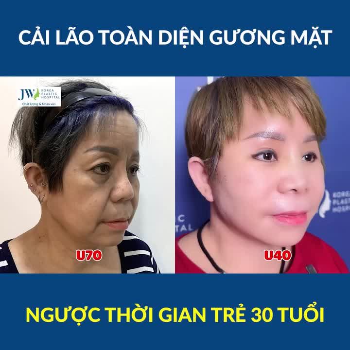 Bác sĩ Tú Dung căng da mặt SMAS, nâng mũi, treo chân mày giúp Việt kiều U70 cười tít mắt TRẺ 30 TUỔI