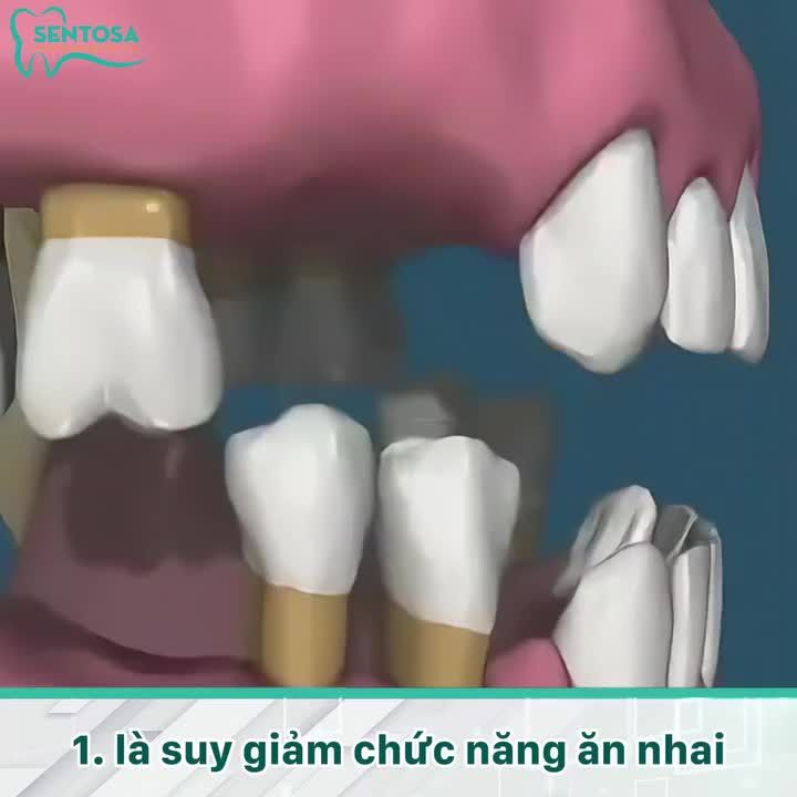 HẬU QUẢ NGHIÊM TRỌNG KHÔNG LƯỜNG TRƯỚC KHI MẤT RĂNG LÂU NĂM