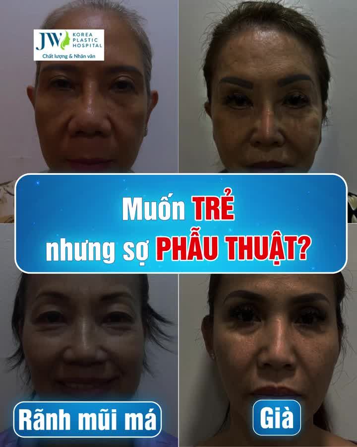 KH Hồng Ngân nhận lại kết quả "ngỡ ngàng" sau 1 tháng cắt mí